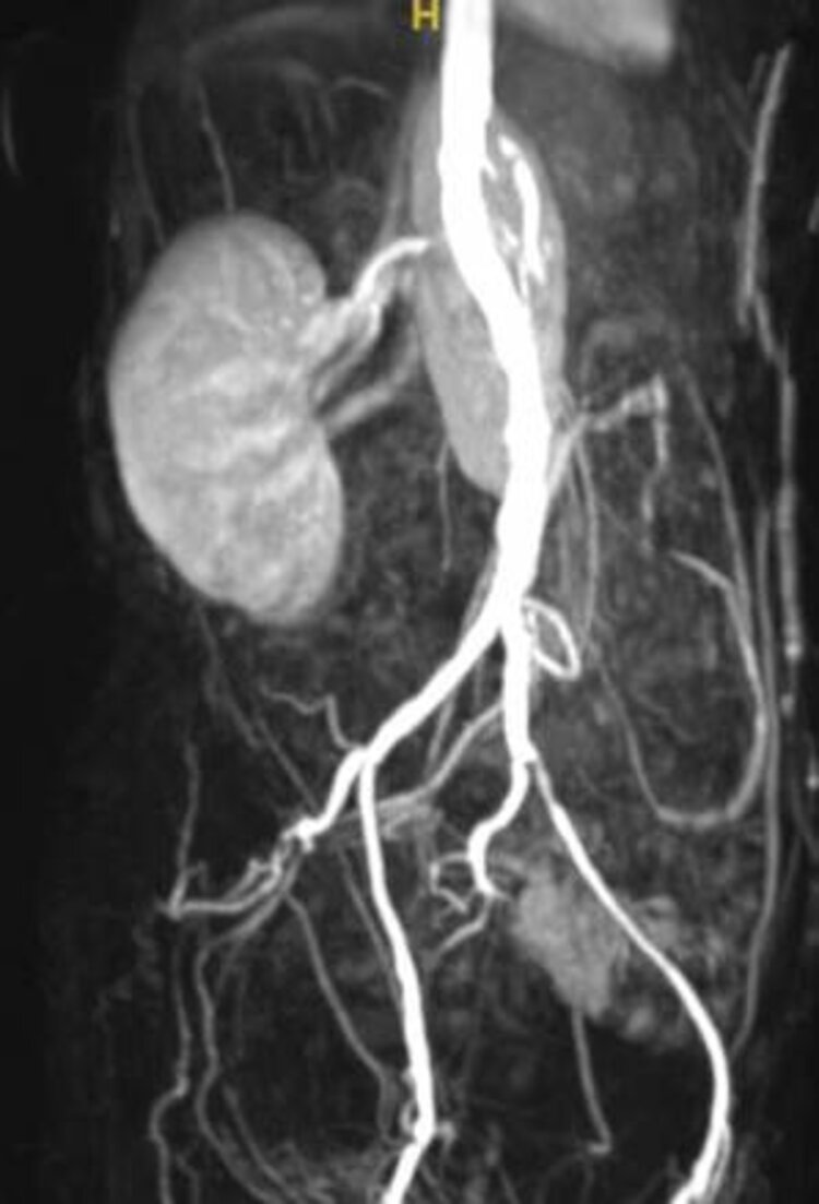 CT-Angiographische Darstellung viszeraler Gefässe und der rechten Niere 