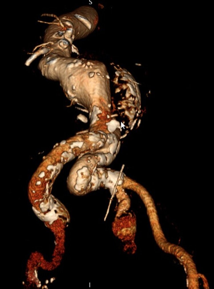 Die dreidimensionale Darstellung der Aorta erlaubt anschliessend eine bessere Darstellung der Aorta und ihrer Äste. Dies hilft bei der Planung endovaskulärer Therapieansätze, sog. EVAR-Eingriffe (EVAR = EndoVascular Aortic Repair).