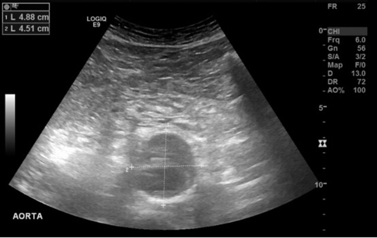 Duplexsonographische Darstellung Aorta abdominalis mit bereits thrombotischem Randsaum.In bestimmten Fällen ist der Schallwinkel nicht ideal anlotbar, so dass die Grösse über- oder unterschätzt wird.