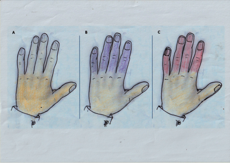 Schematische Darstellung eines Raynaudanfalls. Nach A) anfänglicher Weissverfärbung (Vasospasmus) der Finger kommt es B) zu einer Blauverfärbung (Zyanose) durch venöse Stauung in den Fingern. C) ggf. kann es noch zu einer Rotverfärbung (Hyperämie) kommen (klassisches Trikolore-Phänomern).